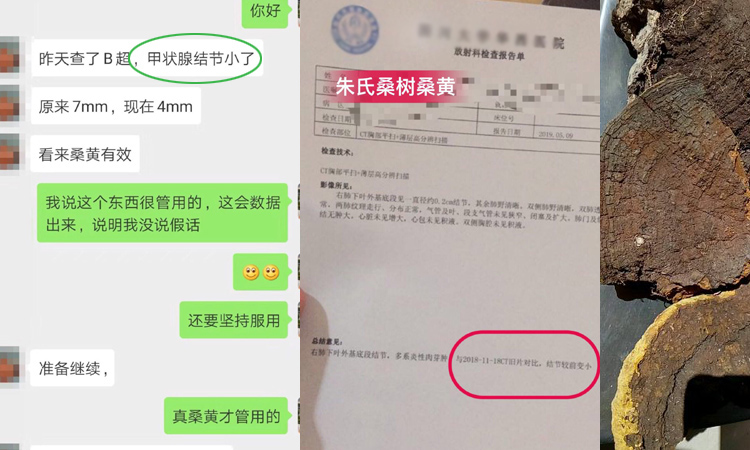 甲狀腺結節吃桑樹桑黃案例 甲狀腺結節吃桑樹桑黃案例